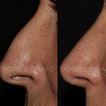 Rhinoplasty 24