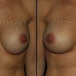 Secondary Breast Surgery 10