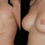 Secondary Breast Surgery 11