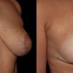 Secondary Breast Surgery 7