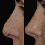 Secondary Rhinoplasty Surgery 13