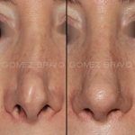 Secondary Rhinoplasty Surgery 12