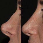 Secondary Rhinoplasty Surgery 9