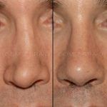 Secondary Rhinoplasty Surgery 10