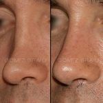 Secondary Rhinoplasty Surgery 8