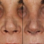 Secondary Rhinoplasty Surgery 7