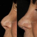 Secondary Rhinoplasty Surgery 6