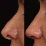 Secondary Rhinoplasty Surgery 4