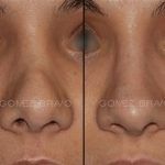 Secondary Rhinoplasty Surgery 2