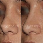 Secondary Rhinoplasty Surgery 1