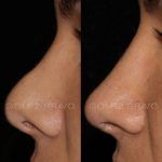 Secondary Rhinoplasty Surgery 14