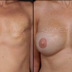 Breast Reconstruction 5