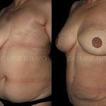 Breast Reconstruction 4