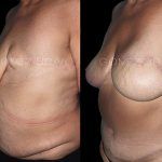 Breast Reconstruction 1