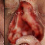 Facial Reconstruction Surgery 5