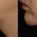 Chin Augmentation 2