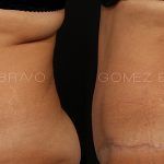 Abdominoplasty 4