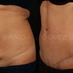 Abdominoplasty 3