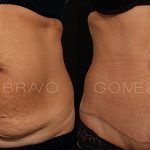 Abdominoplasty 5