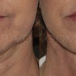 Facelift and Neck Lift 19