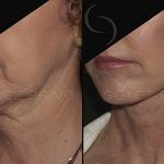 Facelift and Neck Lift 18
