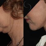 Facelift and Neck Lift 17