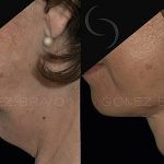Double Chin Correction 2