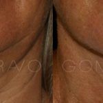 Double Chin Correction 13