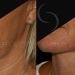 Double Chin Correction 11