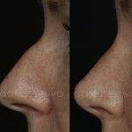 Rhinoplasty 21