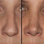 Rhinoplasty 22