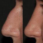 Rhinoplasty 18