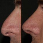 Rhinoplasty 17