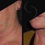 Double Chin Correction 9
