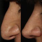 Rhinoplasty 15