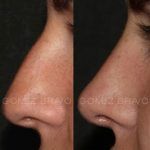 Rhinoplasty 13