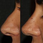 Rhinoplasty 11