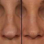 Rhinoplasty 10