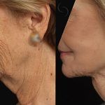 Facelift and Neck Lift 6