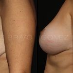 Breast Lift 10