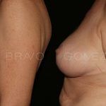 Breast Lift 8