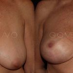 Breast Lift 6