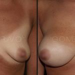 Breast Augmentation 18