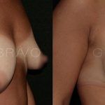 Breast Lift 2