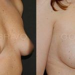 Breast Augmentation 15