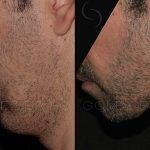 Double Chin Correction 7