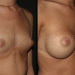Breast Augmentation 9