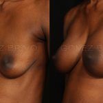 Breast Augmentation 6