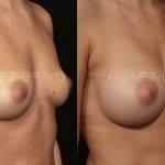Breast Augmentation 5