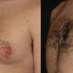 Male Breast Reduction 6
